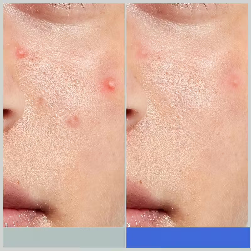 HITWORKER Hydrocolloid Patches